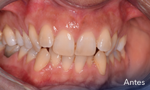 Ortodoncia - antes