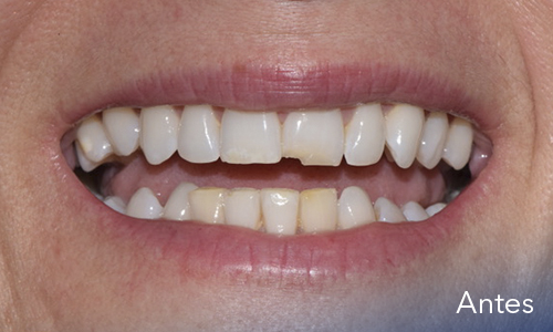 Estética dental (Diseño de sonrisas) - antes