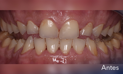 Rehabilitación oral - antes