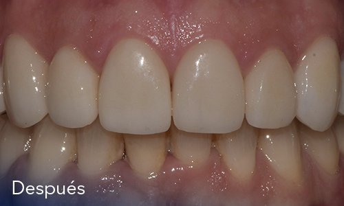 Estética dental (Diseño de sonrisas)