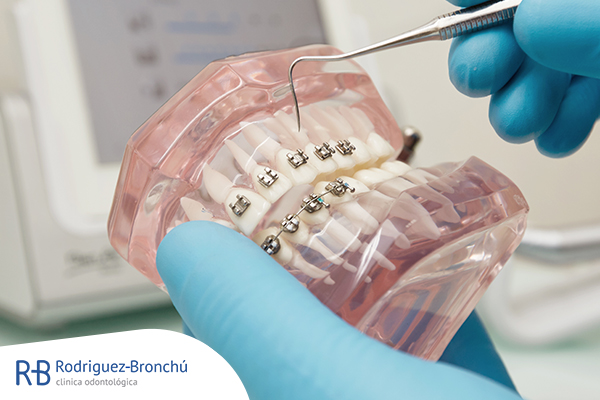 Tratamiento de ortodoncia y brackets estéticos