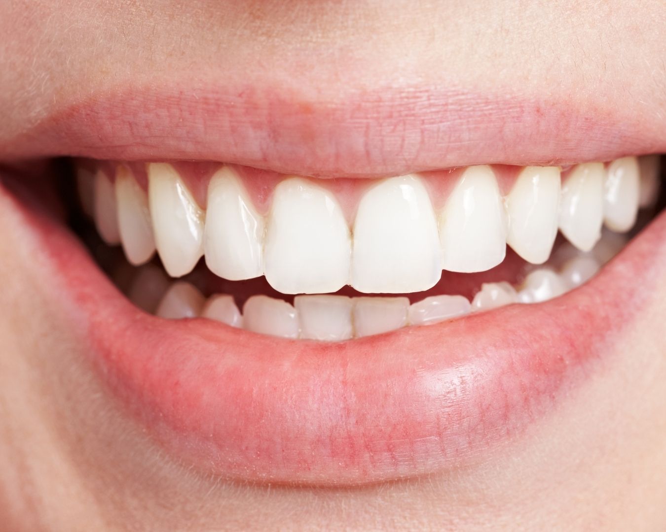 diseno-de-sonrisa-175