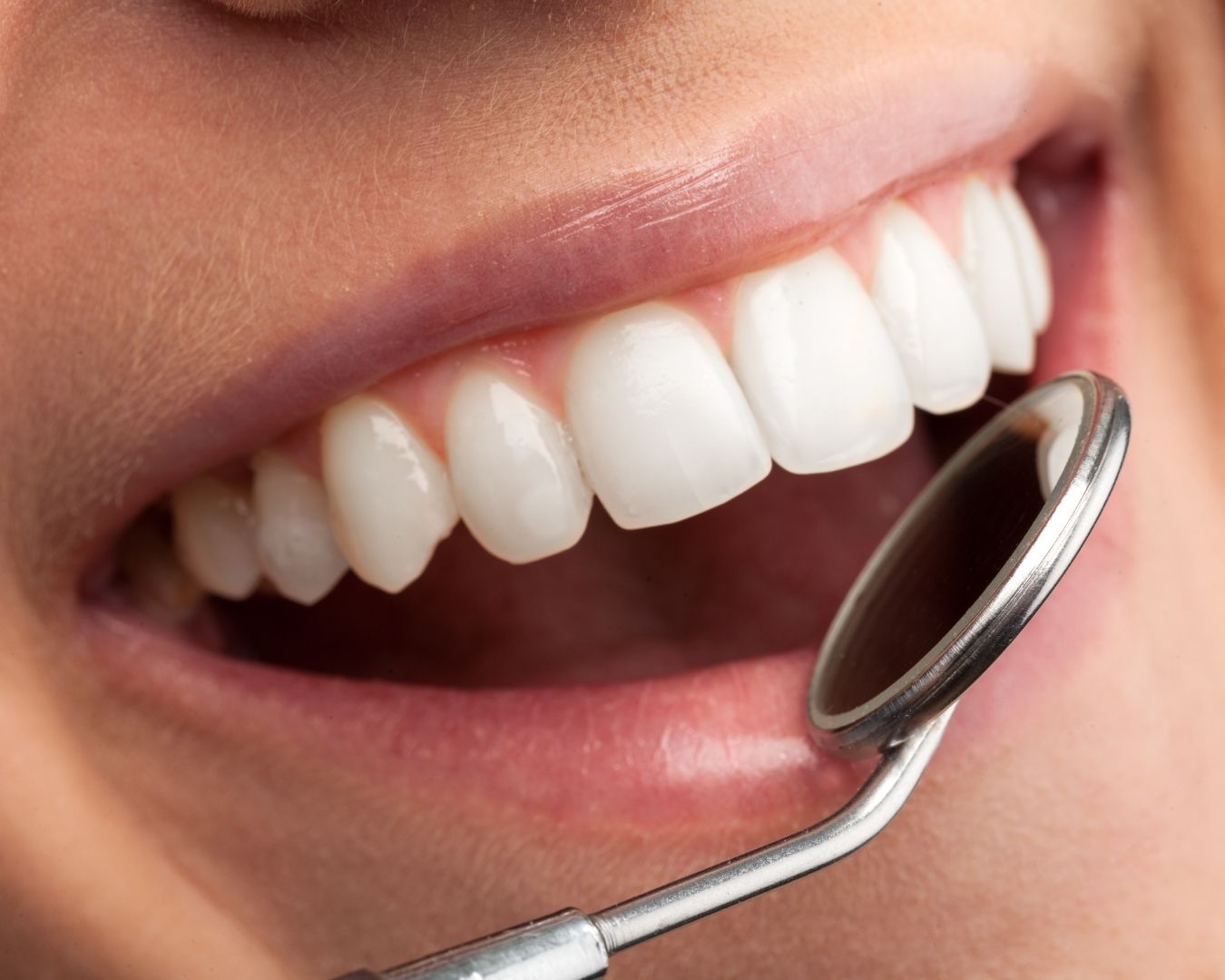 diseno-de-sonrisa-180