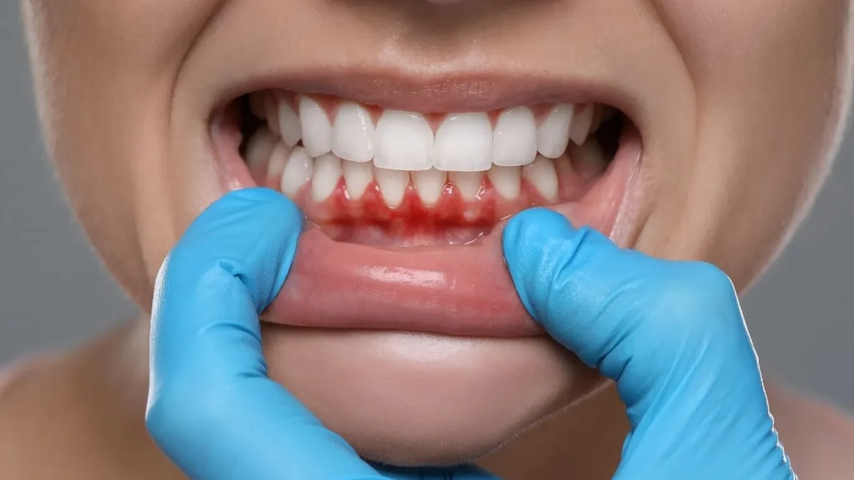Periodontitis vs gingivitis: por qué no es lo mismo y qué cambia el tratamiento | Rb Clínica Odontológica Periodontitis vs gingivitis: por qué no es lo mismo y qué cambia el tratamiento | Rb Clínica Odontológica