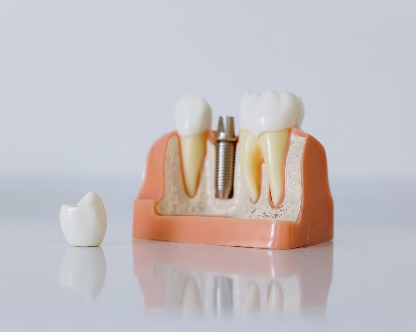 Qué es una prótesis dental Modelo dental con un implante, una corona y dientes naturales